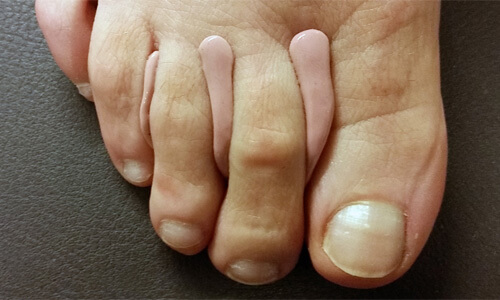 Protectieve orthesiologie, problemen aan Digitus V