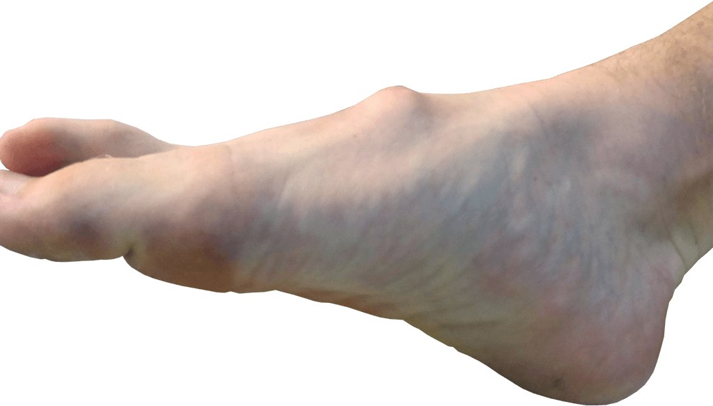 Voet met een zichtbare verdikking op de wreef (tarsal boss)